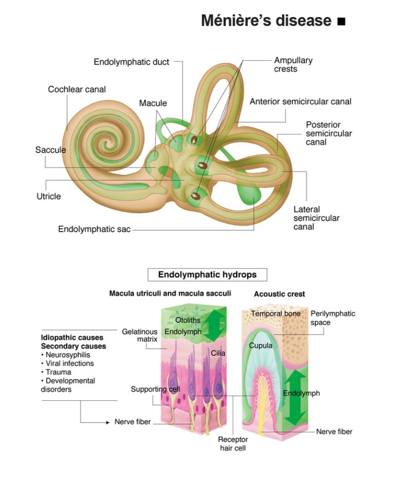 Infografis Meniere